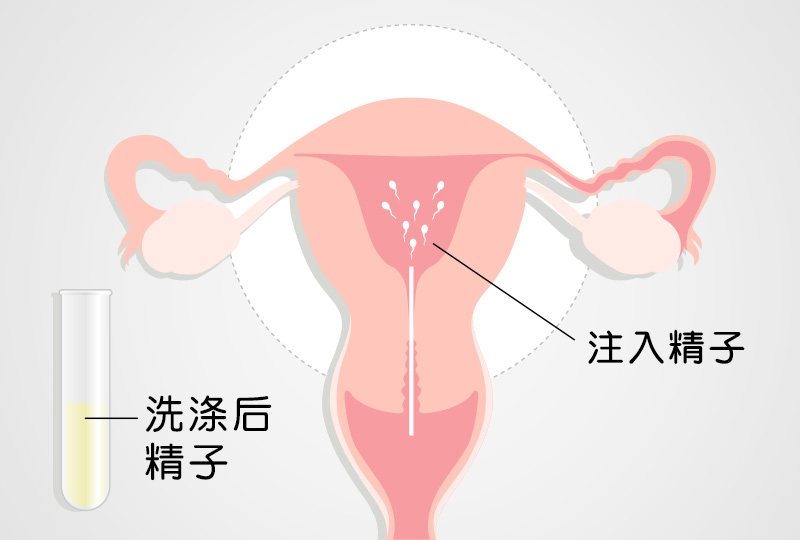 人工受精-安安试管婴儿中心,不孕症,试管婴儿,人工受孕,冷冻卵子