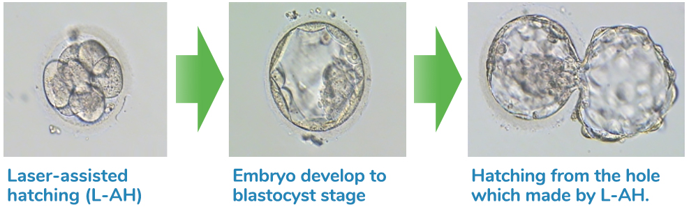  鐳射胚胎孵育術-安安試管嬰兒中心,不孕症,試管嬰兒,人工受孕,冷凍卵子