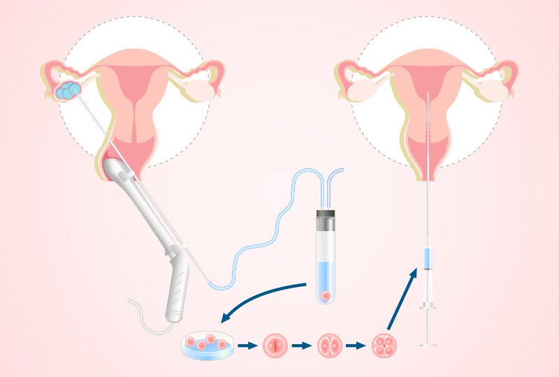 In Vitro Fertilization (IVF)