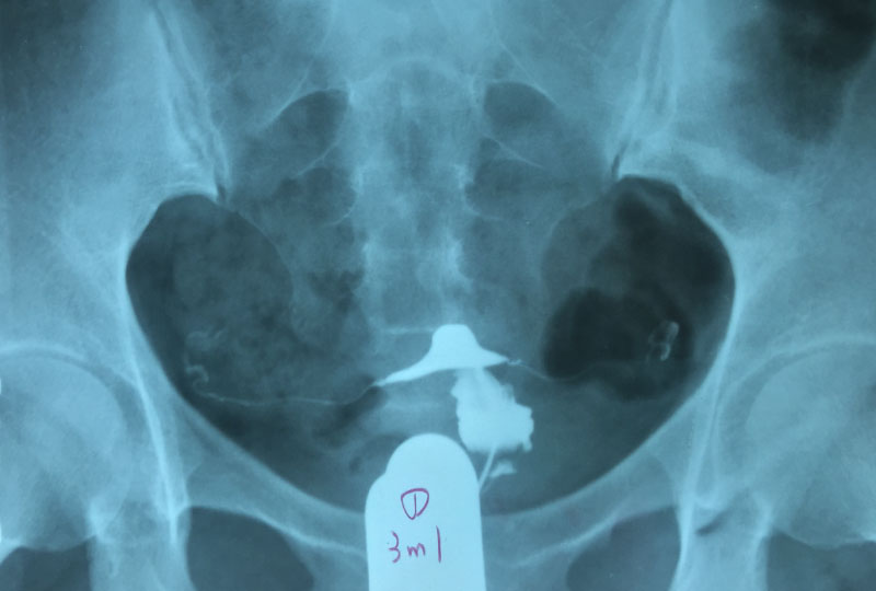 Hysterosalpingogram examination (HSG)