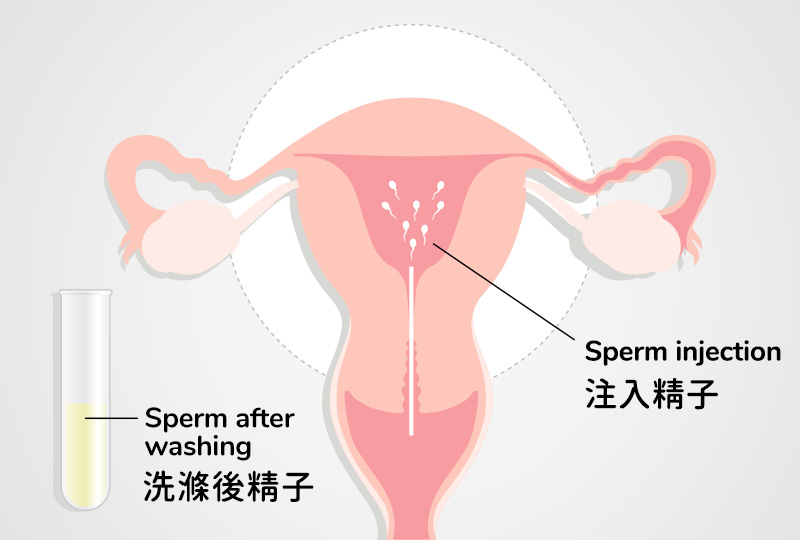 Intrauterine Insemination (IUI)